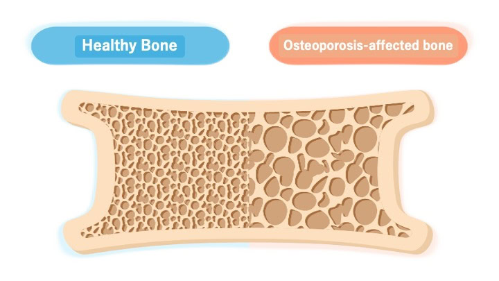 Bone Mineral Density Measurement